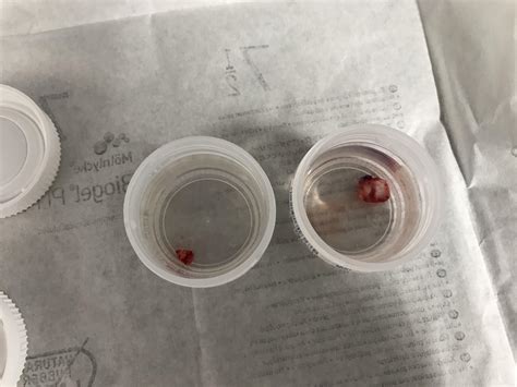 A couple little fellas out of my neck : r/popping