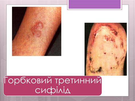 Сифіліс. Класифікація сифілісу - презентация онлайн