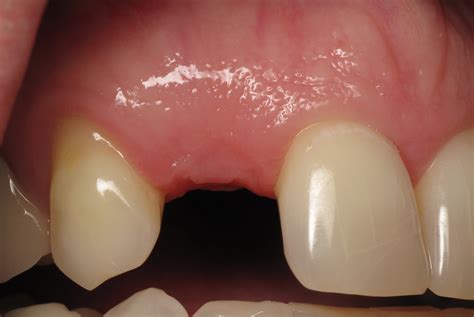 can gum line be fixed 9