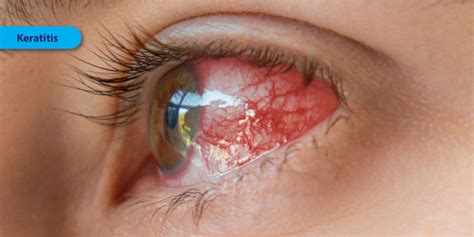 Keratitis - Symptoms, Causes and Treatment | FYEyes