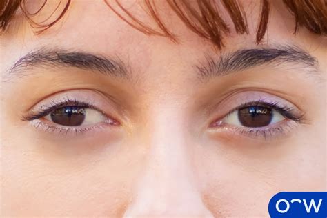 Crossed Eyes (Strabismus): Definition, Types, Causes, Symptoms, and ...