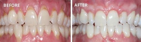 Gingival Graft Before And After