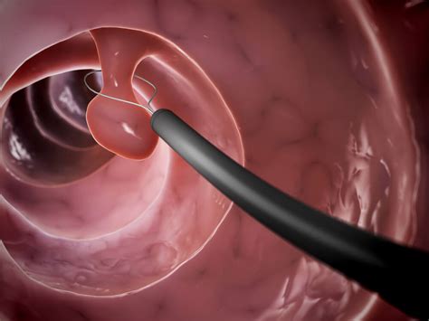 O Que É Polipo Uterino - Sintomas dos pólipos uterinos e como eles se formam?