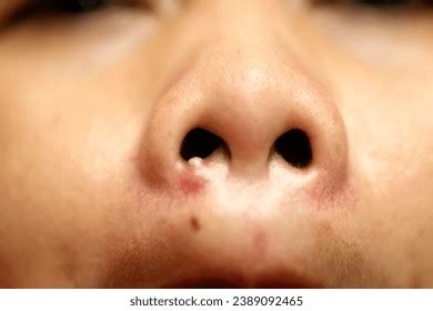 31 Pimples Inside Mouth Images, Stock Photos, 3D objects, & Vectors ...