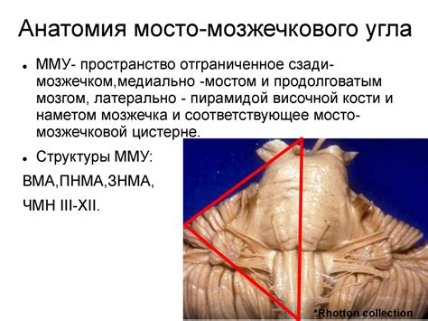 Внемозговые опухоли мостомозжечкового угла. Вестибулярная шваннома ...