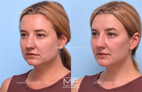 Complete Facial Rejuvenation or Contouring Before and After Pictures