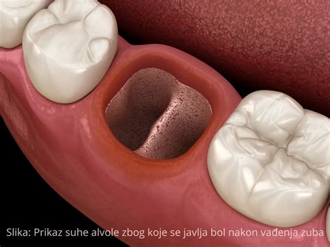 Bol nakon vađenja zuba | Potraži pomoć stomatologa