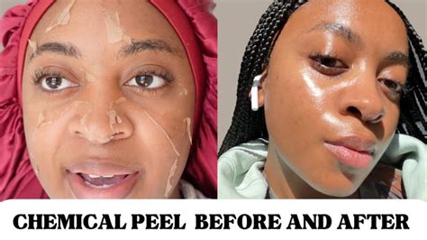 Before and After: African American Chemical Peel for Black Skin | Actualizado abril 2024