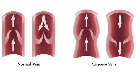 Varicose Vein Surgery - Net Health Book