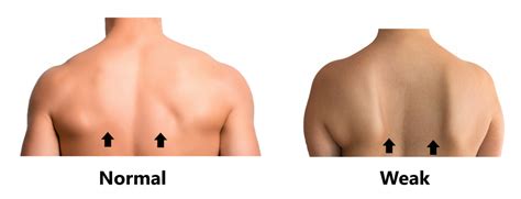 scapula stability  family physio