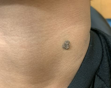 Epidermal Nevus (EN) | School of Medicine