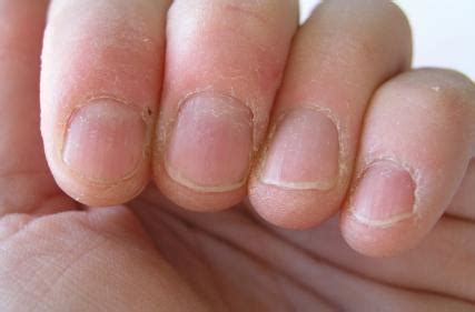 compulsive skin picking cuticles lovetoknow health wellness