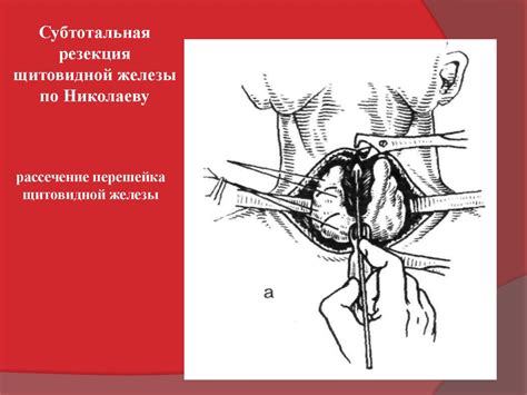 Операции на щитовидной железе - презентация онлайн