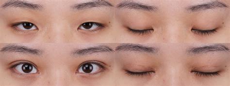 small incision mini dissection orbicularis preservation