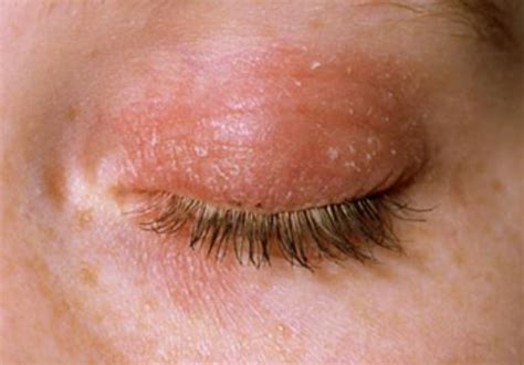 Causes of Dry Eyelids, Treatments and Home Remedies - Skincarederm