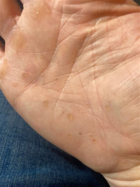 AAGAB-pEDD (palmoplantar Epidermal Differentiation Disorder)