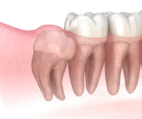 Wisdom Tooth with Impaction at Molar Tooth. Medically Accurate Tooth 3D ...