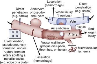 Vascular Complications in Spinal Surgery | Musculoskeletal Key