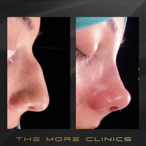 turkey rhinoplasty guide  cost nose job turkey