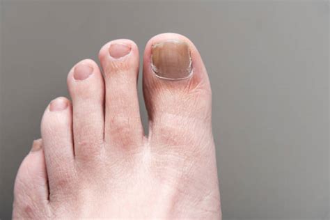 630+ Manchas Blancas En Las Uñas De Los Pies Fotografías de stock ...