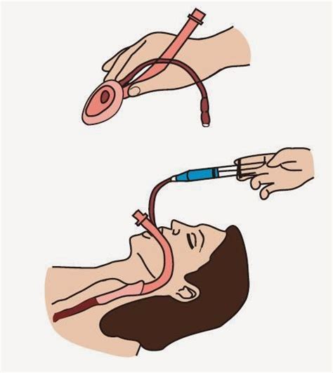 Laryngeal Mask Airway (LMA) ~ Nursing