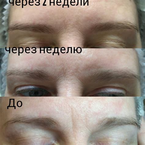 Ботулинотерапия, Гипергидроз подмышек — вулиця Святошинська, 6, Киев ...