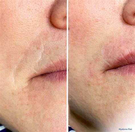 Hyalax Bulgaria - Dermal fillers and mesotherapy - HYALAX® REVITALIZE ...