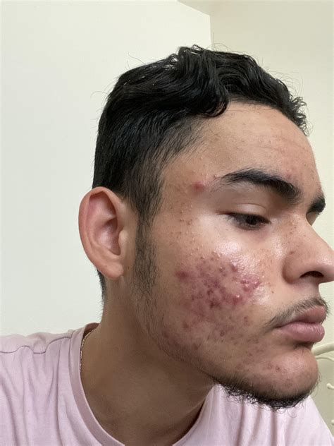 [Skin Concerns] How to reduce inflammation? I’ve struggled with this