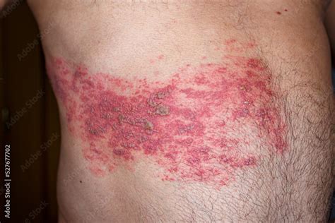 skin lesion symptom  shingles  herpes zoster  human shingles