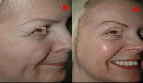 Botox Injections - Eye Surgeons Associates PC