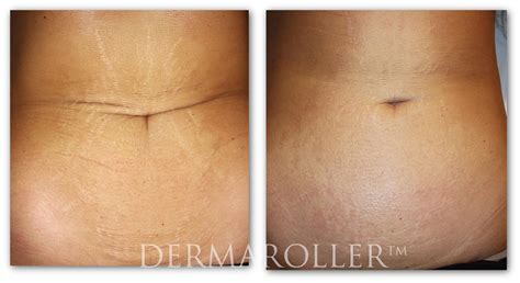 Are Derma Rollers Good For Stretch Marks at Thomas Marriott blog