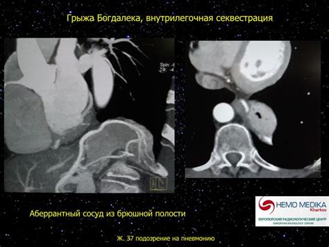 Диафрагмальные грыжи. Что нужно знать радиологу?