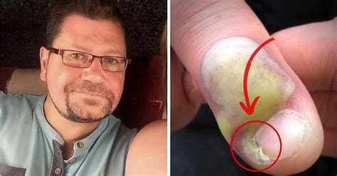 Roer Unhas Faz Mal - Infecção na unha por roer: homem passa por cirurgia e quase morre