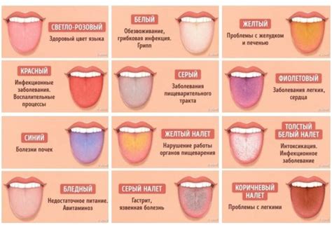 Географический язык у ребенка: 8 причин появления, методы лечения