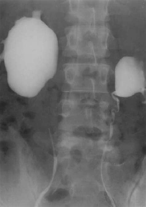 bilateral retrograde pyelography  bilateral ureteropelvic