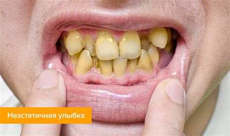 Коронки на передние зубы — какие лучше поставить — Startsmile