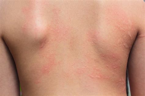 Keto Rash: Reasons and Healthy Ways to Avoid It during Your Diet