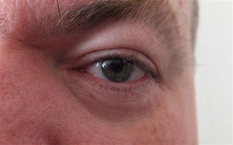 reasons   eyelid  swollen swollen eyelid vrogueco