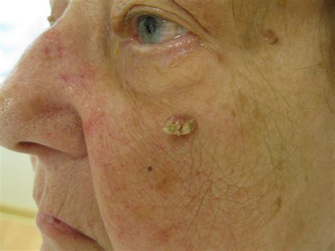 Squamous Cell Carcinoma of the Skin - Dermatology Advisor