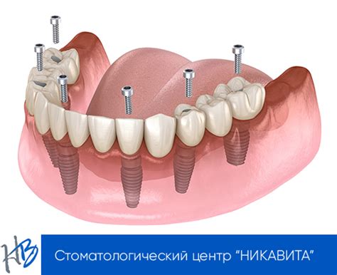 Несъемные протезы в Минске, цены на несъемные протезы