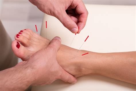 Can Acupuncture Help with Foot Pain?