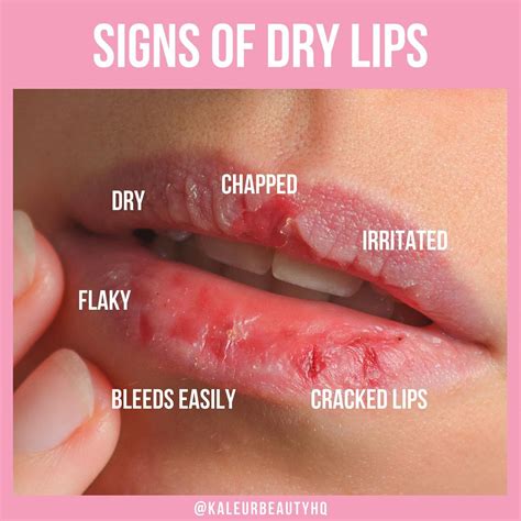 👆🏼Check if You Have These Common signs of DRY LIPS👆🏼 - Do you have the ...