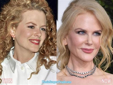 Did Nicole Kidman Have Facelift & Lip Augmentation?