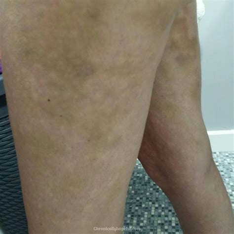 Histamine intomerance – Artofit