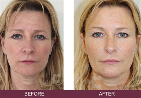 Dermaforce face lift – Glamorous by Sam