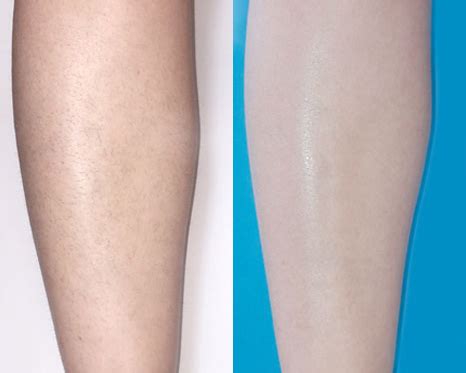 Hair Removal - Vein & Laser Institute