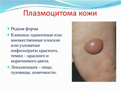 Гемодермии и ретикулезы - презентация онлайн