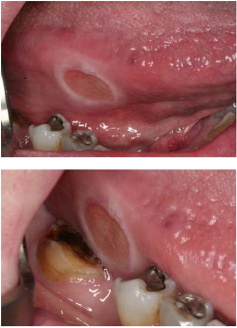 2. Traumatic ulcer
