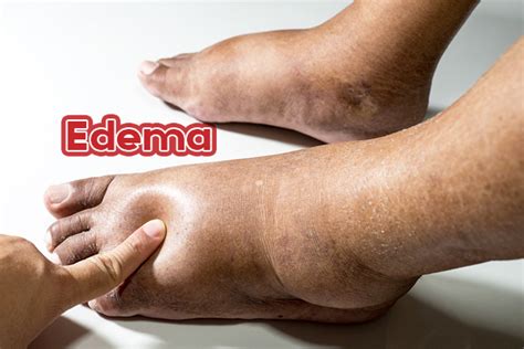 Edema - Clínica Médica Porter
