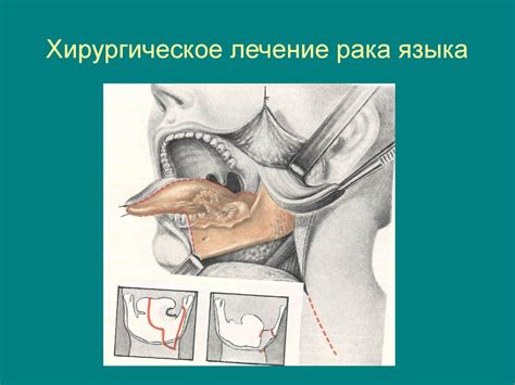 Опухоли нижней губы, языка и полости рта - презентация онлайн